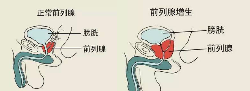 中年男人最怕得这种病，选择手术的人肠子悔青，其实有2个常用的中成药就可治根。